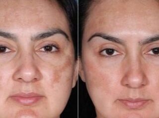 Before and after recovery program