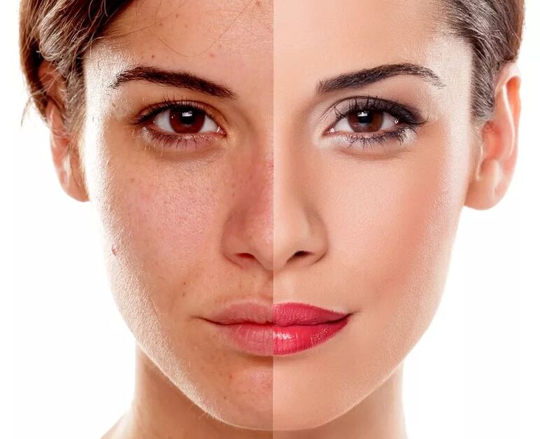 Flat skin tone